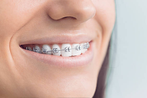 Best Traditional Braces  in Delshire, OH